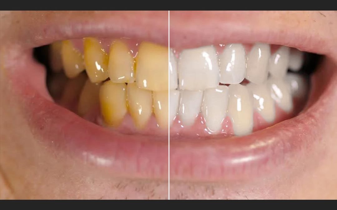 How to Whiten Teeth in Photoshop – Tutorial